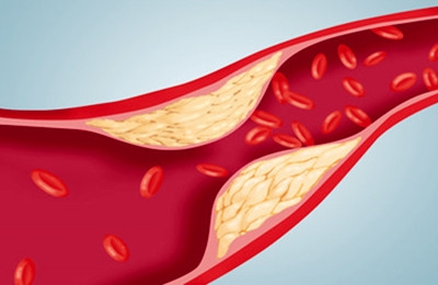 血管健康：对抗动脉硬化的有效营养疗法
